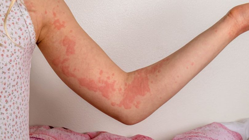 what-do-hives-look-like-symptoms-and-treatment